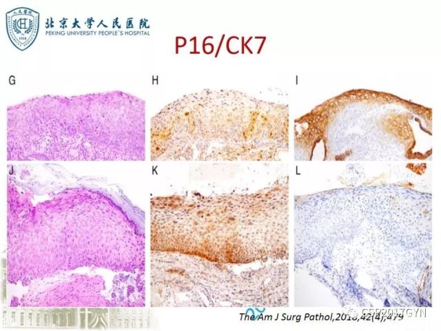 宫颈鳞状上皮内病变病理诊断中问题