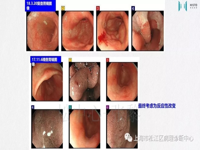 上消化道早癌病理诊断中的困惑及基本对策回顾