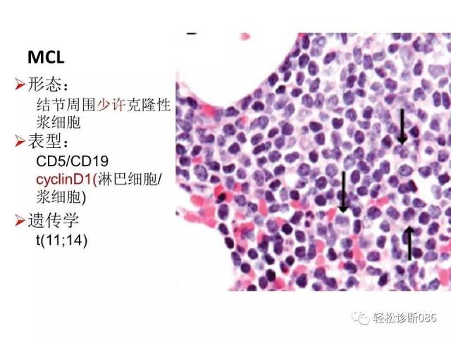 浆细胞相关肿瘤的病理诊断及鉴别诊断