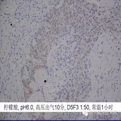 《常规免疫组化初筛ALK阳性非小细胞肺癌专家共识》技术部分解读