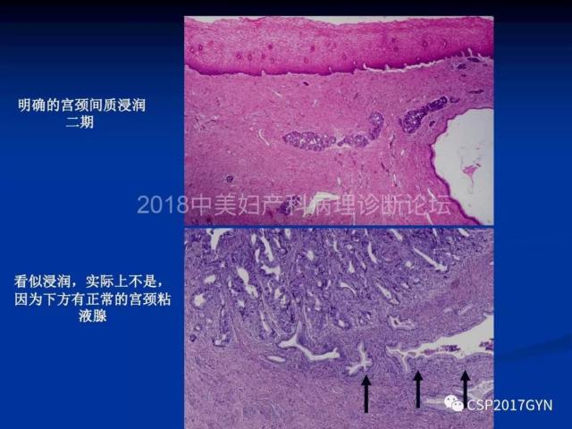 子宫内膜癌：诊断与进展