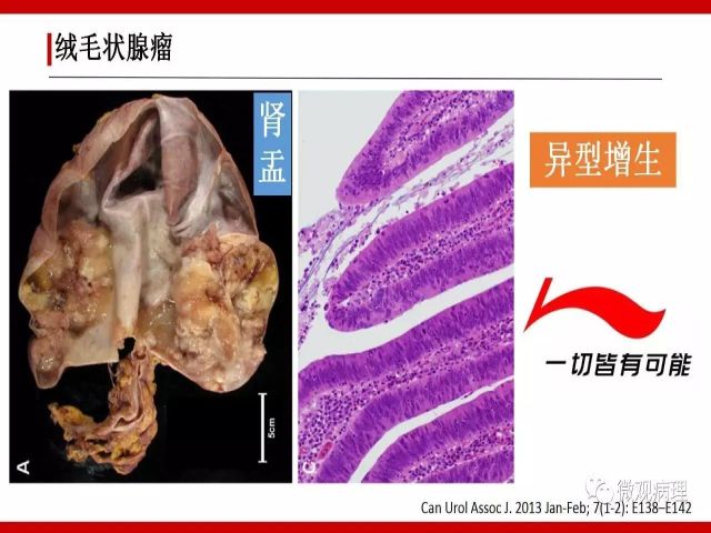 泌尿课程/尿路腺样病变的诊断要点