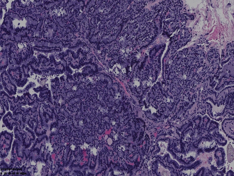 这个甲状腺肿瘤怎么看？