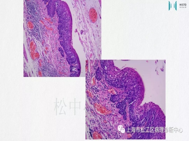 上消化道早癌病理诊断中的困惑及基本对策回顾