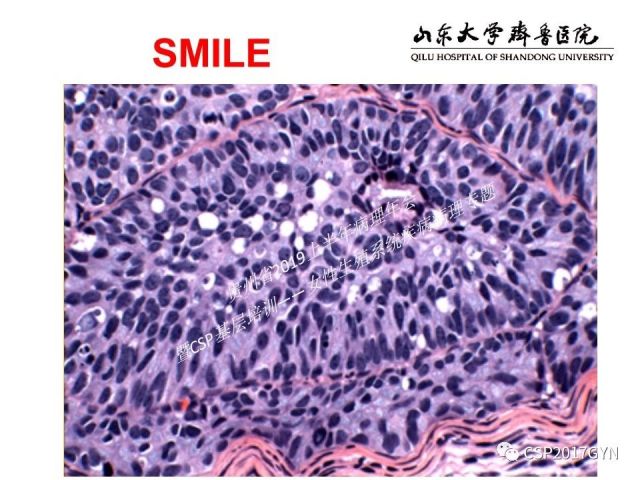 中华病理学会基层培训遵义站讲座（四）——宫颈腺癌的诊断及新分型