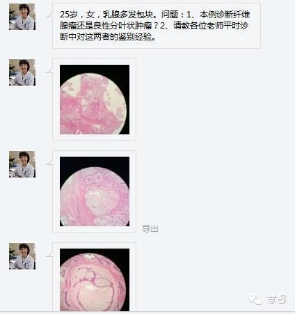 乳腺纤维腺瘤与叶状肿瘤的鉴别要点（李军红分享，孔祥田老师讲解）