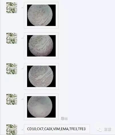 透明细胞乳头状肾细胞癌？TFE3 Traslocation Carcinoma？（赵洋分享，孔祥田(Max)*NM老师讲解）