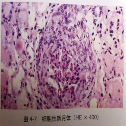 硅结节和新月体形成的病理变化