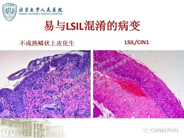 中华病理学会基层培训遵义站讲座（三）——宫颈鳞状上皮病变的病理诊断与鉴别诊断