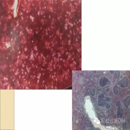 滤泡性淋巴瘤