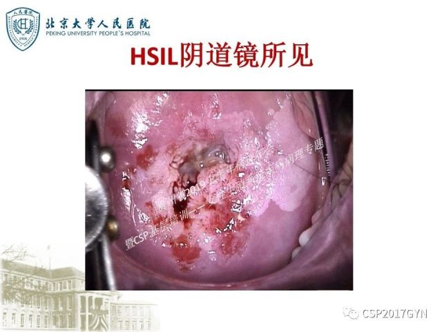 中华病理学会基层培训遵义站讲座（三）——宫颈鳞状上皮病变的病理诊断与鉴别诊断
