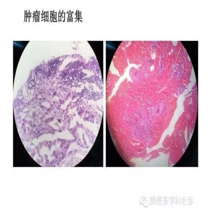 EGFR基因突变检测--基础篇