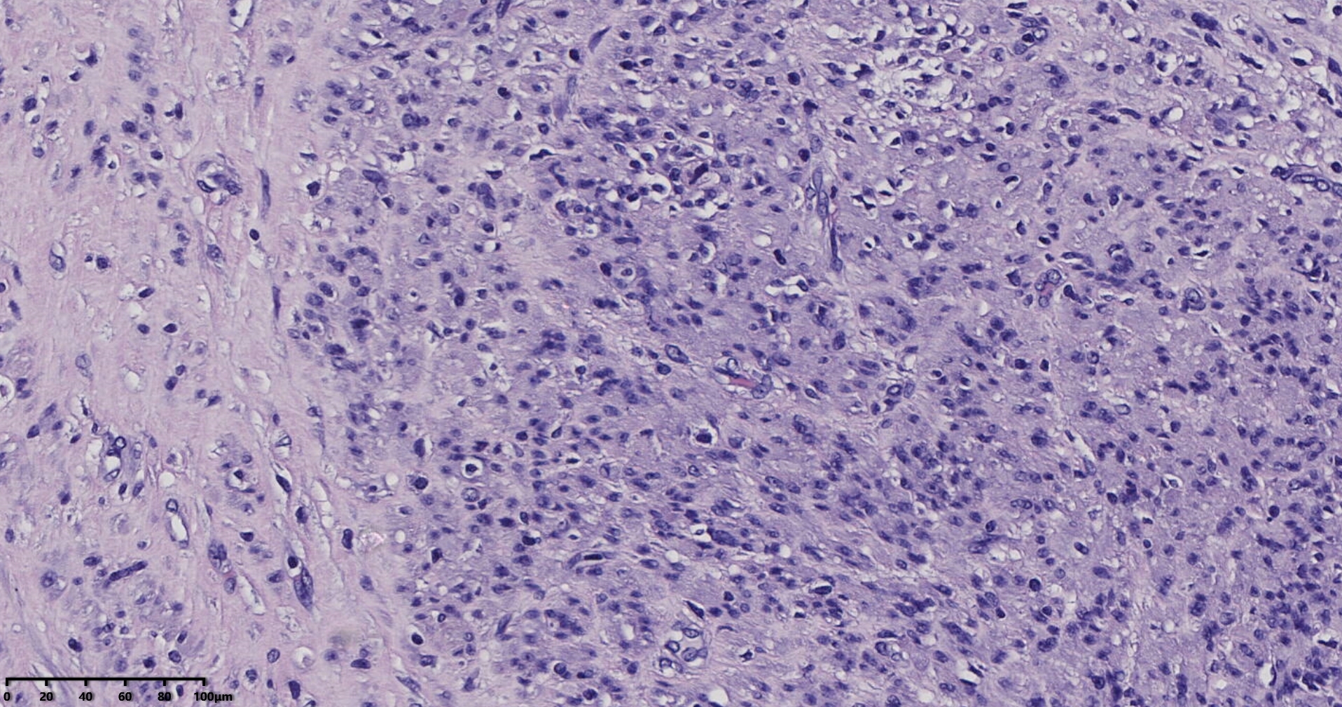 子宫多发性平滑肌瘤伴肉瘤