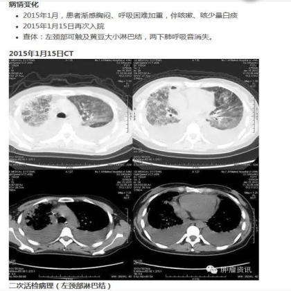 中日韩个体化诊疗案例大赛经典赏析之十——驱动基因双突变，两种靶向药物均无效，个体化治疗的阿克琉斯之踵