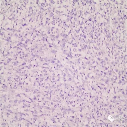 甲状腺癌乳头状癌伴未分化癌（肉瘤样癌）分化