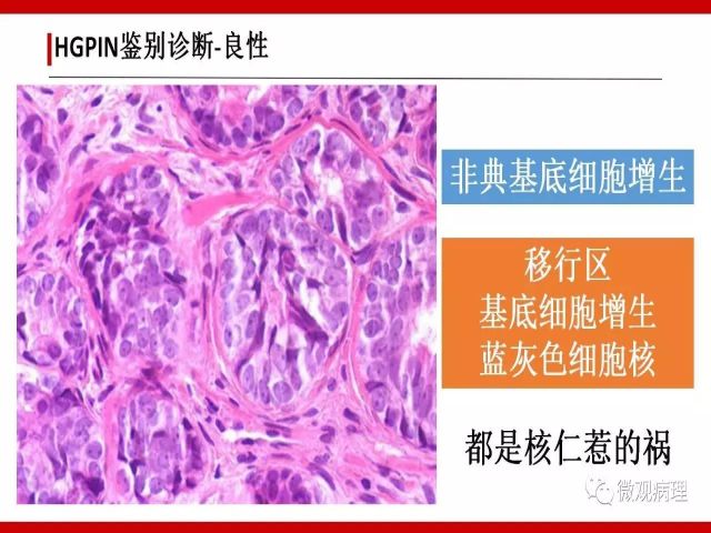 泌尿课程/一个中心,两个基本点:HGPIN诊断概要 泌尿课程/一个中心,两个基本点:HGPIN诊断概要
