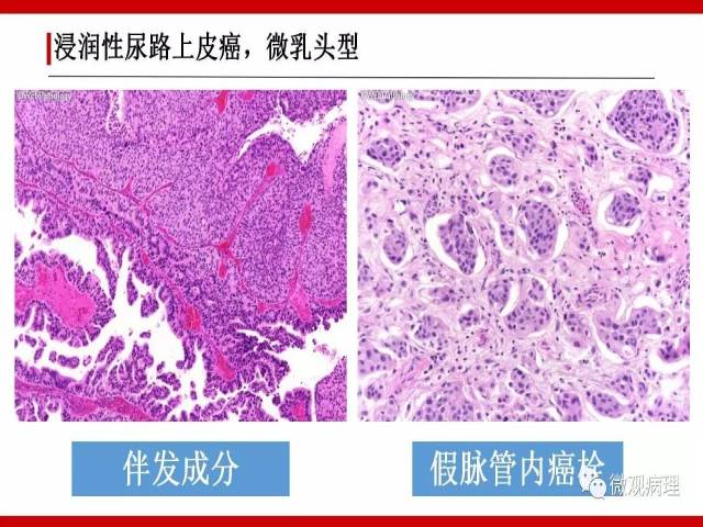 泌尿课程/浸润性尿路上皮癌病理学类型