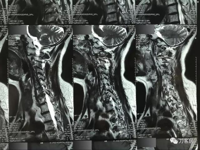 医生及患者通用:如何用手机翻拍X线片,磁共振片子,CT片子进行网络求医、病例讨论及保留资料 医生及患者通用:如何用手机翻拍X线片,磁共振片子,CT片子进行网络求医、病例讨论及保留资料