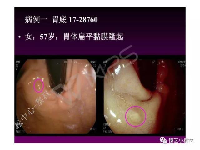 上消化道早癌病理的学习心得体会（附胃牵手癌的病例特点文献学习）