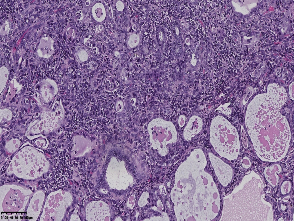 子宫透明细胞癌？