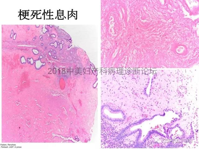 子宫内膜假肿瘤性病变及类似癌样病变