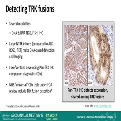 The efficacy of LOXO-101,a selective TRKI, in adult and pediatric TRK fusion cancers