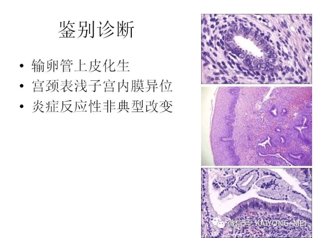 宫颈腺性病变的病理诊断及进展（一）