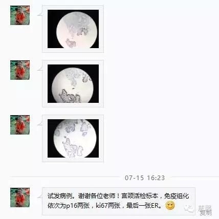 宫颈腺体原位癌及绒毛状管状腺癌的问题（未雨分享，刘从容老师讲解）