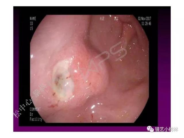 上消化道早癌病理的学习心得体会（附胃牵手癌的病例特点文献学习）
