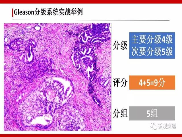 前列腺癌Gleason分级系统的前世今生