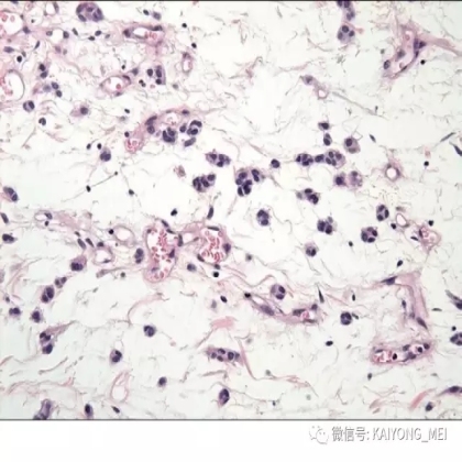女性生殖道软组织肿瘤病理诊断及进展（二）