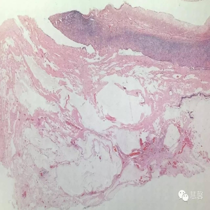 低级别黏液性肿瘤转移到卵巢伴腹腔假黏液瘤形成【小车】分享；【刘从容】老师讲解
