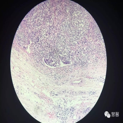 胃癌化疗后黏膜无癌、黏膜下广泛癌栓（慧馨分享，孔祥田(Max)*Roswell）