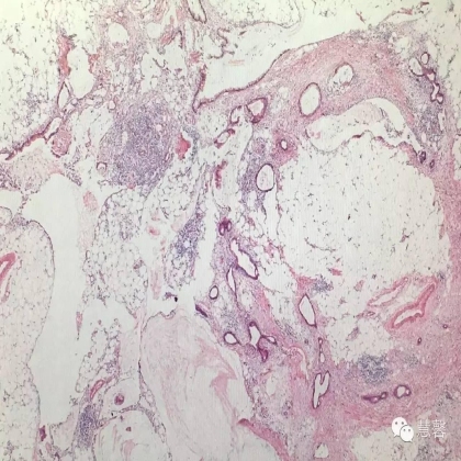 低级别黏液性肿瘤转移到卵巢伴腹腔假黏液瘤形成【小车】分享；【刘从容】老师讲解