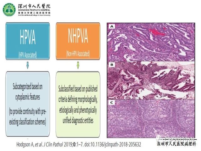 2019USCAP妇科病理热点介绍