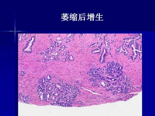 前列腺病理诊断线索（下）——黄教悌