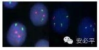 急性粒细胞白血病(AML)FISH检测
