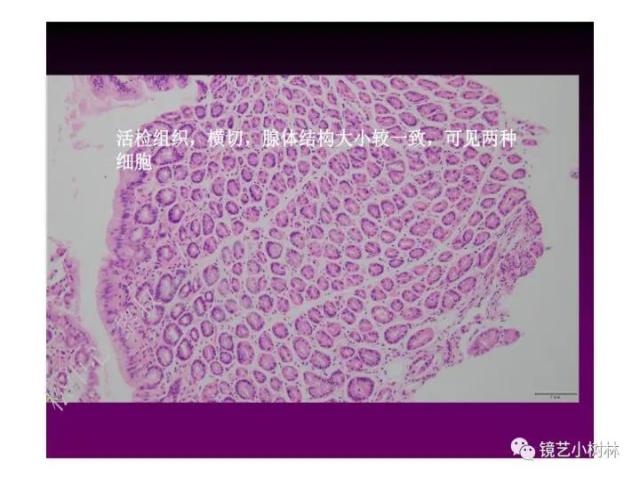 上消化道早癌病理的学习心得体会（附胃牵手癌的病例特点文献学习）