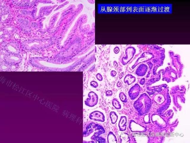 上消化道低级别上皮内瘤变的那些事