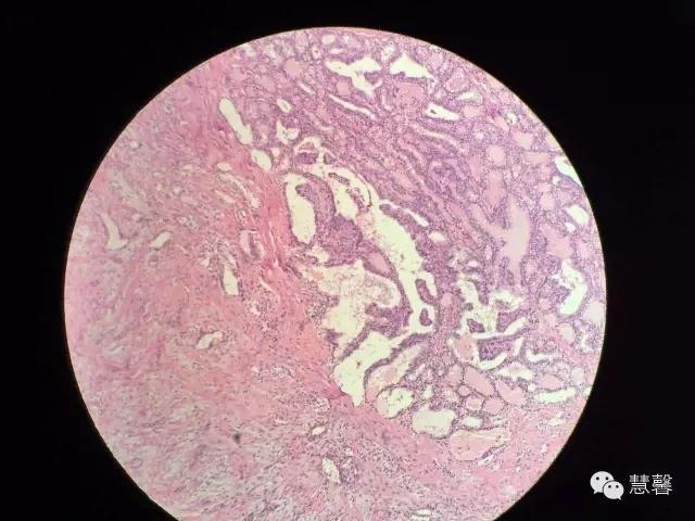 甲状腺乳头状癌伴喉返神经旁淋巴结中见小块分化好的甲状腺组织，转移癌？（阿姚分享，孔祥田(Max)*Roswell*NM老师讲解）