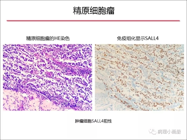 泌尿病理--精原细胞瘤VS精母细胞瘤