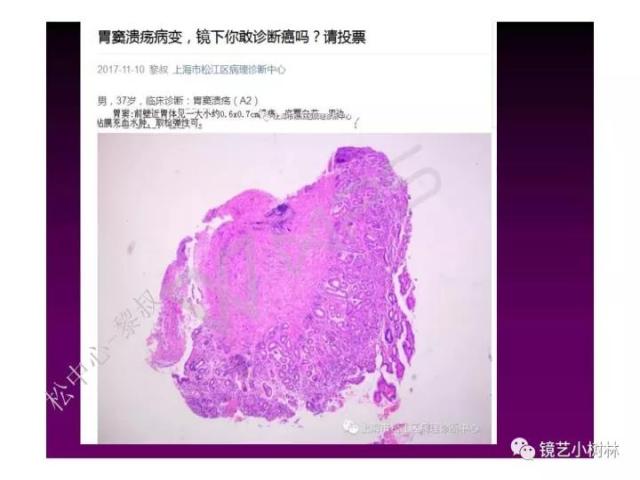 上消化道早癌病理的学习心得体会（附胃牵手癌的病例特点文献学习）