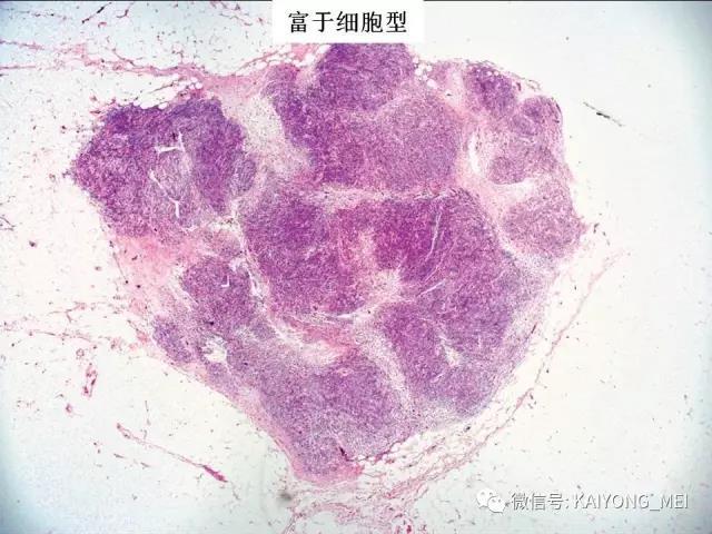 乳腺梭形细胞病变的病理诊断及进展（一）