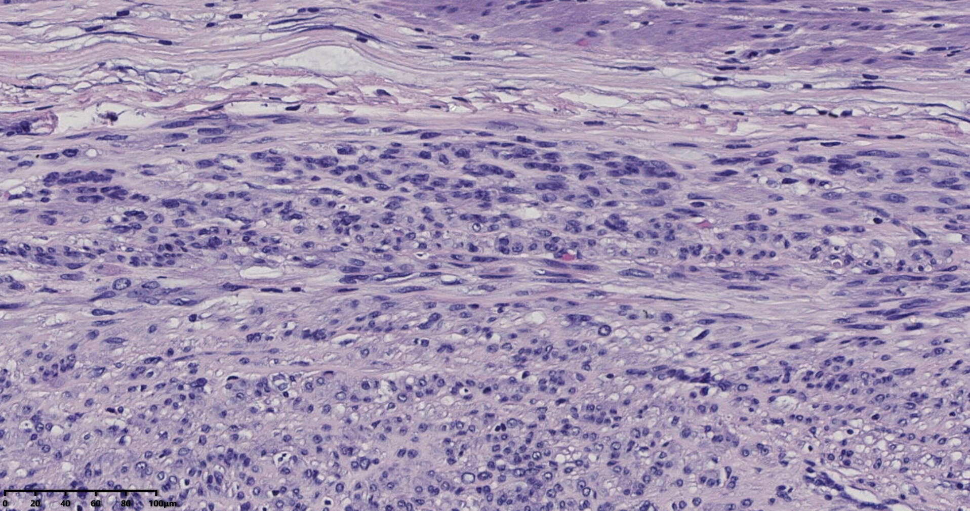 子宫多发性平滑肌瘤伴肉瘤