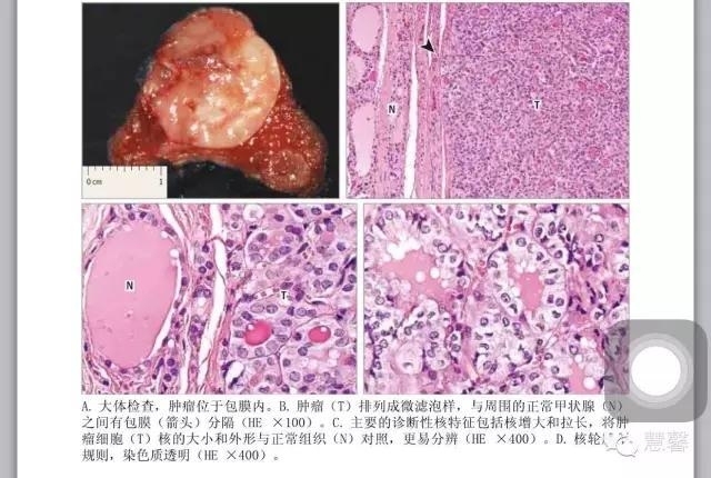 非浸润性包裹性滤泡型甲状腺乳头状癌（EFVPTC）的重新命名（根据原文翻译）