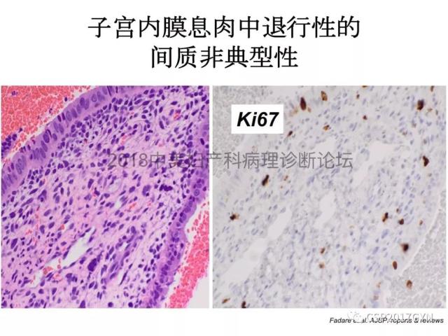 子宫内膜假肿瘤性病变及类似癌样病变