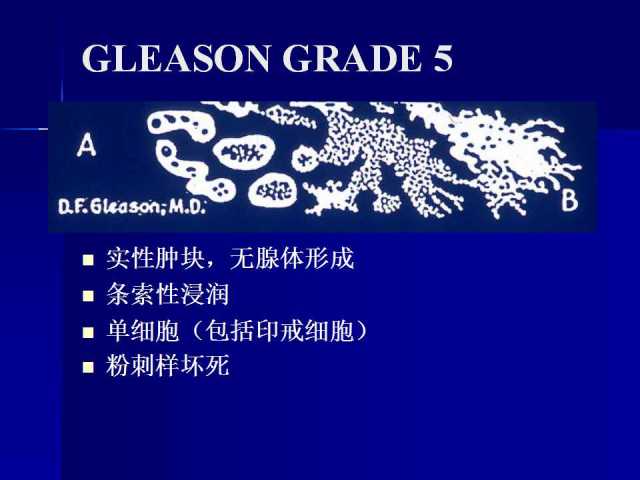 前列腺病理诊断线索（下）——黄教悌