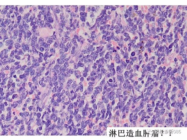 BPDCN病例分享