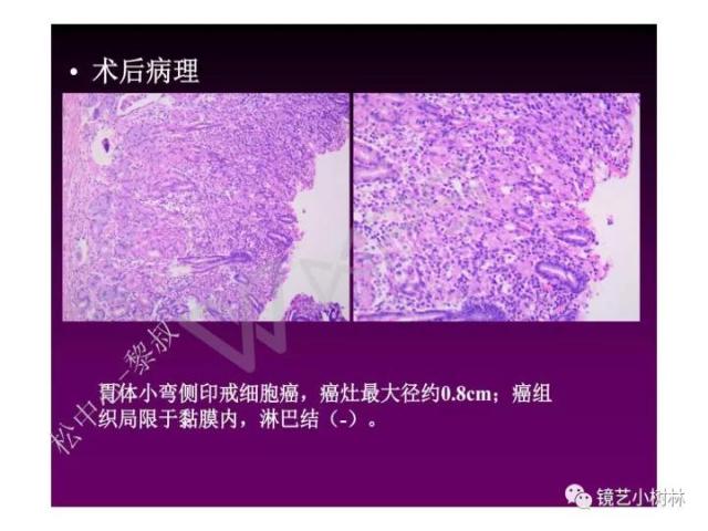 上消化道早癌病理的学习心得体会（附胃牵手癌的病例特点文献学习）
