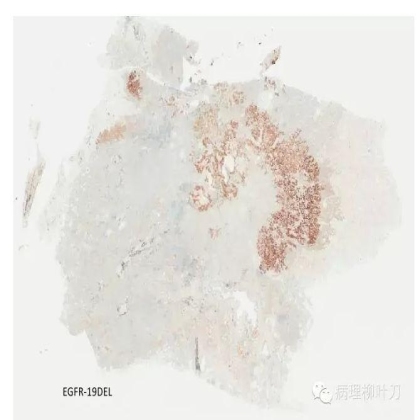 肿瘤精确医疗与分子病理检测
